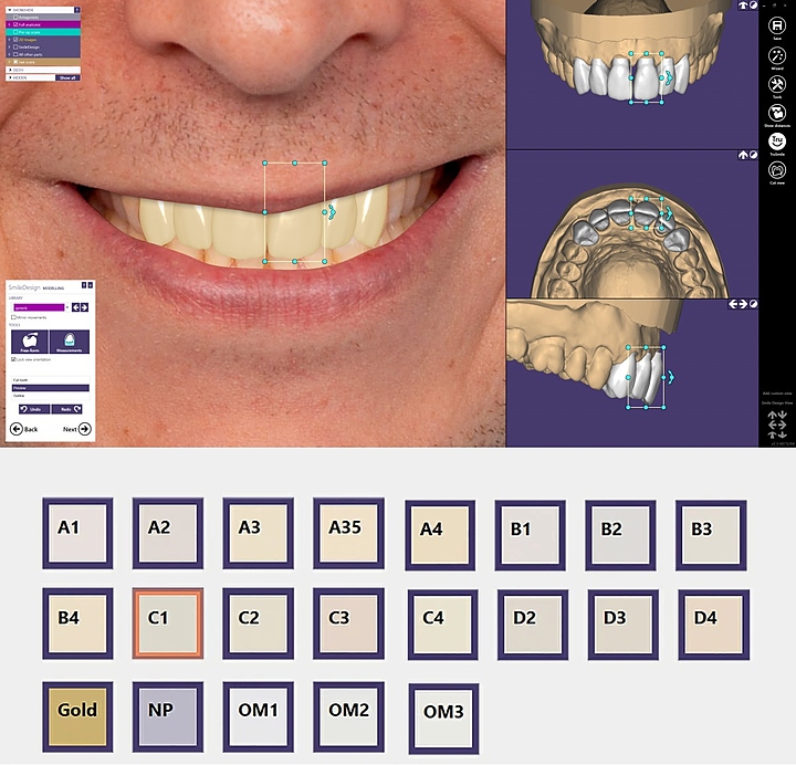 Модуль для программного обеспечения Exocad Smile Creator