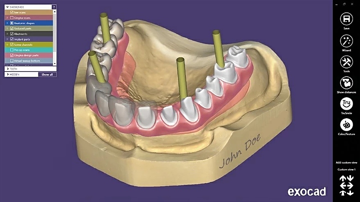 Модуль для программного обеспечения Exocad Implant module